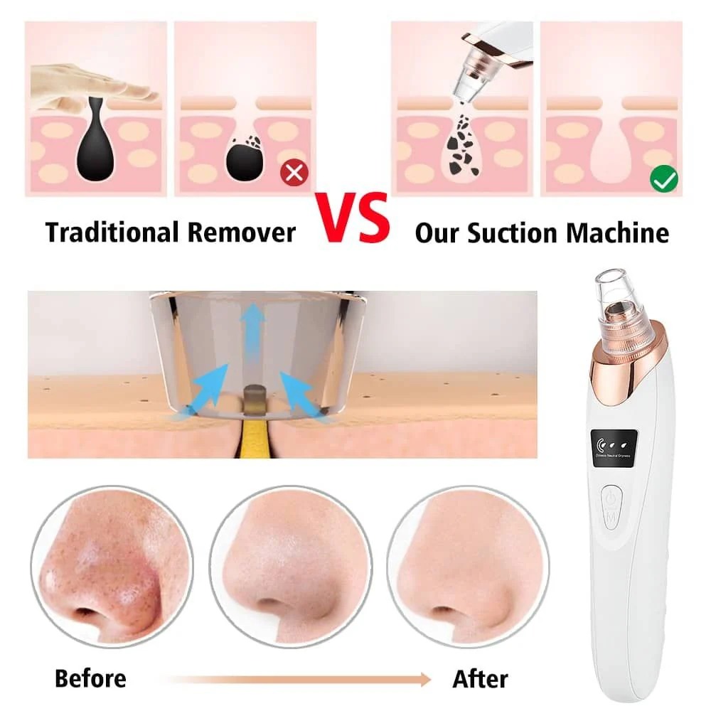 Electric Blackhead Remover - Image 4
